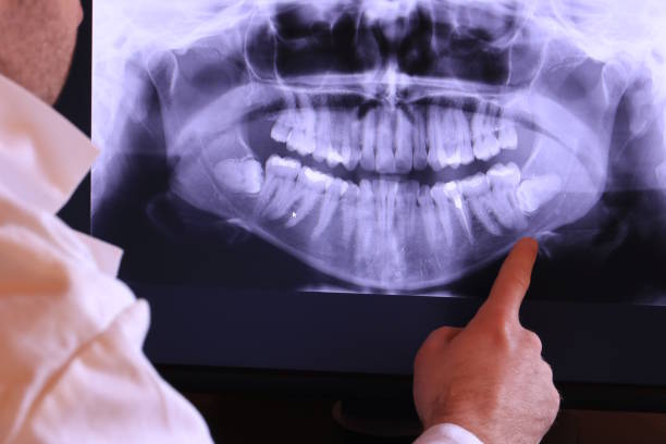 Best Emergency Dental Extractions in Yarrow Point, WA